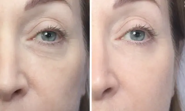 Prima e dopo biorivitalizzazione occhiaie: pelle più liscia e luminosa sotto gli occhi.
