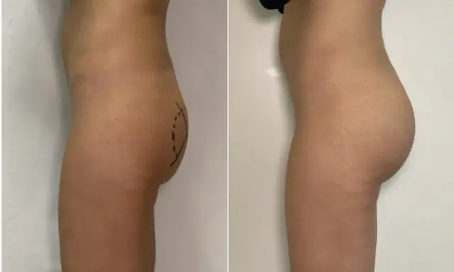 Prima e dopo gluteoplastica mini invasiva: un aumento del volume e della proiezione dei glutei, con un risultato naturale.