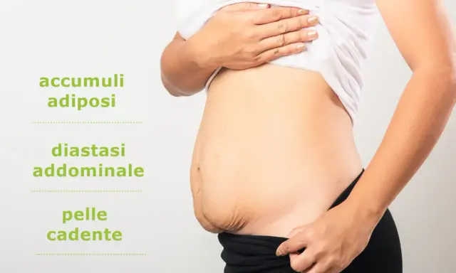 Addominoplastica cos'è: immagine mostra addome con accumuli adiposi, diastasi addominale e pelle cadente, condizioni trattabili.