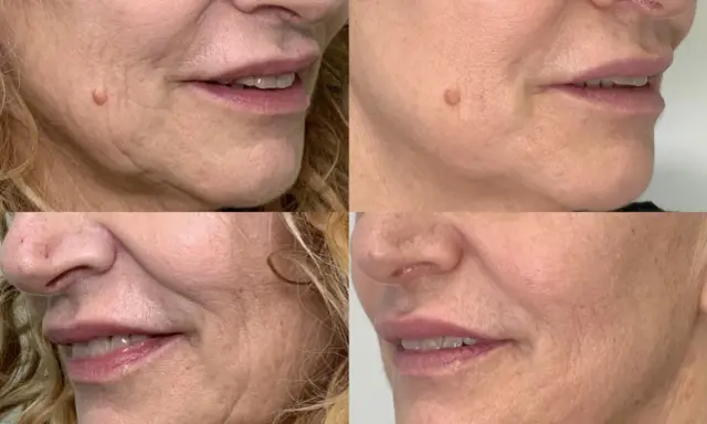 Punture di vitamine viso prima e dopo: la pelle appare più liscia e luminosa, con una riduzione delle rughe e un aspetto più giovane.