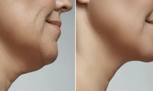 Prima e dopo criolipolisi doppio mento: recensioni positive per un viso più definito e giovane.