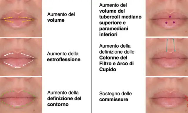 Filler per migliorare volume, estroflessione, definizione contorno, tubercoli, colonne del filtro, arco di Cupido e sostegno delle commissure della bocca.