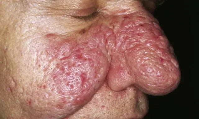 Primo piano del naso e guancia di un uomo con rinofima. La pelle è arrossata, ispessita e presenta noduli. Potrebbe essere utile una crema per rinofima.