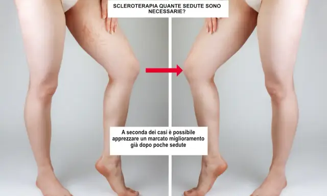 Gambe prima e dopo sclerosanti: la terapia riduce visibilmente le teleangectasie, mostrando un netto miglioramento.