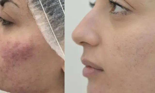 Prima e dopo: pelle con acne e rossori, poi migliorata. Nessun effetto collaterale visibile di Dermamelan.
