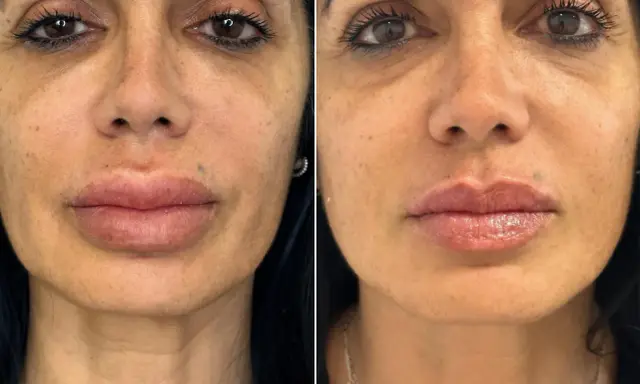 Volto prima e dopo ialuronidasi: labbra più definite e pelle più liscia.