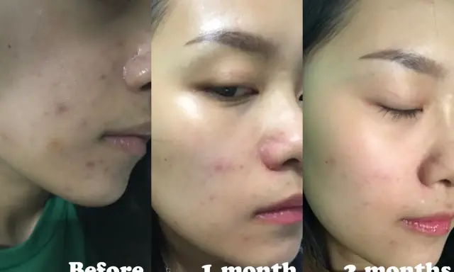 Acne migliorata con acido salicilico: prima, dopo 1 mese e dopo 2 mesi.