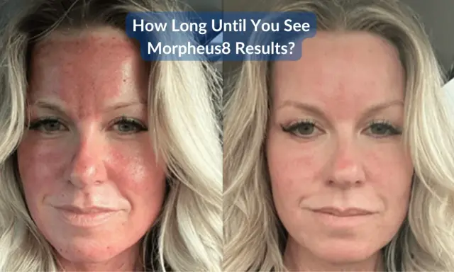Prima e dopo Morpheus8: il volto arrossato e irritato solleva dubbi sui risultati.