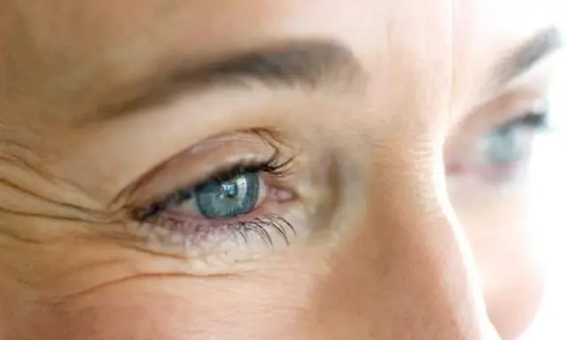 Occhio con evidenti zampe di gallina, un segno del tempo che il botox può attenuare per un aspetto più giovane.