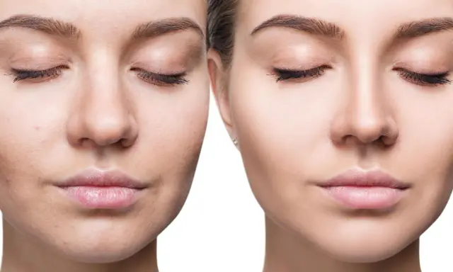 Viso prima e dopo: pelle imperfetta e spenta a sinistra, pelle luminosa e levigata a destra.