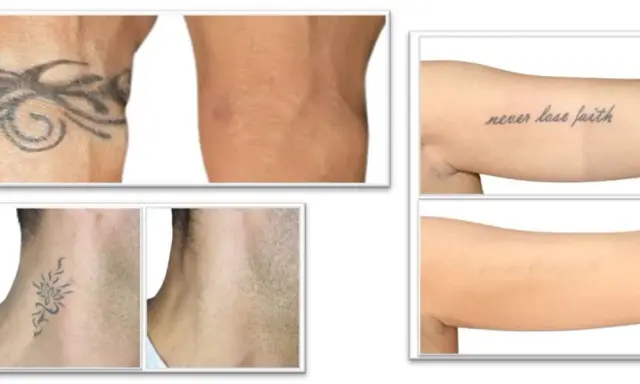 Prima e dopo la rimozione tatuaggi: braccio con tatuaggio tribale e braccio senza, collo con tatuaggio floreale e collo senza, braccio con scritta "never lose faith" e braccio senza.