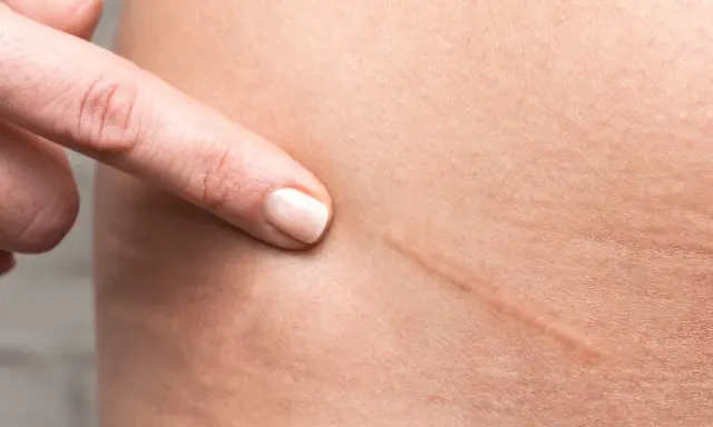 Dito indica una cicatrice da taglio, un segno che si può eliminare per una pelle più liscia.