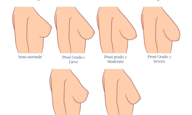 Illustrazione dei gradi di ptosi mammaria: seno normale, lieve, moderata, severa, pseudo ptosi e maldistribuzione. Il seno rifatto può diminuire nel tempo.