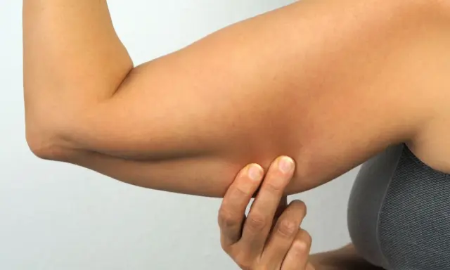 Braccia con pelle raggrinzita dopo dimagrimento, evidenziata da dita che pizzicano la cute.