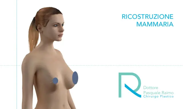 Modello 3D di un torace femminile, con aree evidenziate per illustrare la mastectomia e la ricostruzione mammaria.