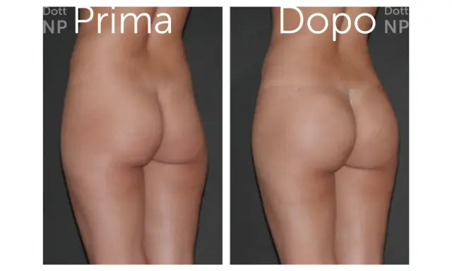 Prima e dopo gluteoplastica senza protesi: un risultato naturale e armonioso.