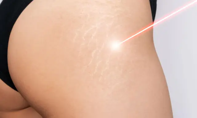 Laser treatment on skin with smagliature, showing a path to come eliminare le smagliature.
