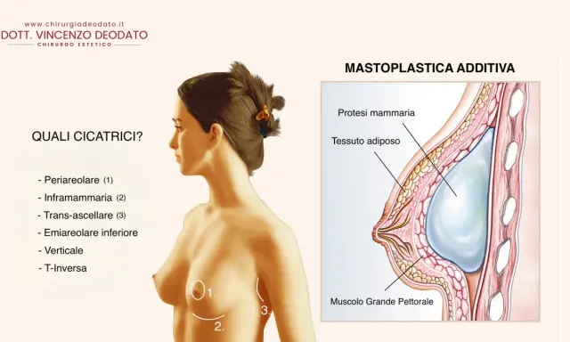 Illustrazione anatomica di un seno con protesi mammaria. Si evidenziano le possibili cicatrici post-mastoplastica e la posizione della protesi rispetto al muscolo pettorale.