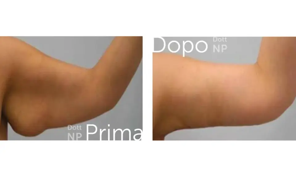 Prima e dopo liposuzione braccia: un braccio più tonico e definito.