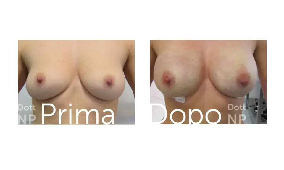 Prima e dopo: un confronto visivo che mostra un aumento del volume del seno, trasformando tette piccole in forme più piene e definite.