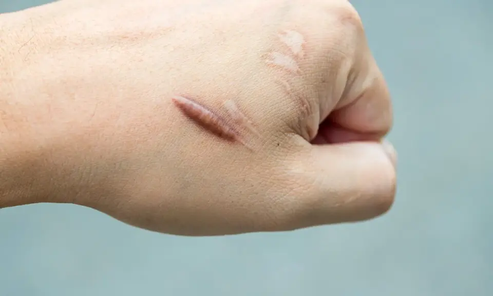 Mano con cicatrice cheloide evidente, un esempio di cheloide prima e dopo il trattamento.