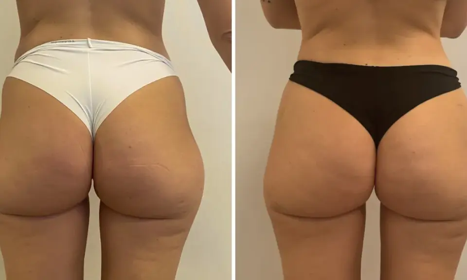 Lipofilling glutei prima e dopo: confronto visivo dei risultati. I glutei appaiono più voluminosi e armoniosi dopo il trattamento.