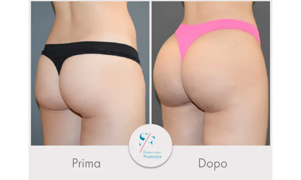 Risultati vaser lipo prima e dopo: glutei più voluminosi e scolpiti.