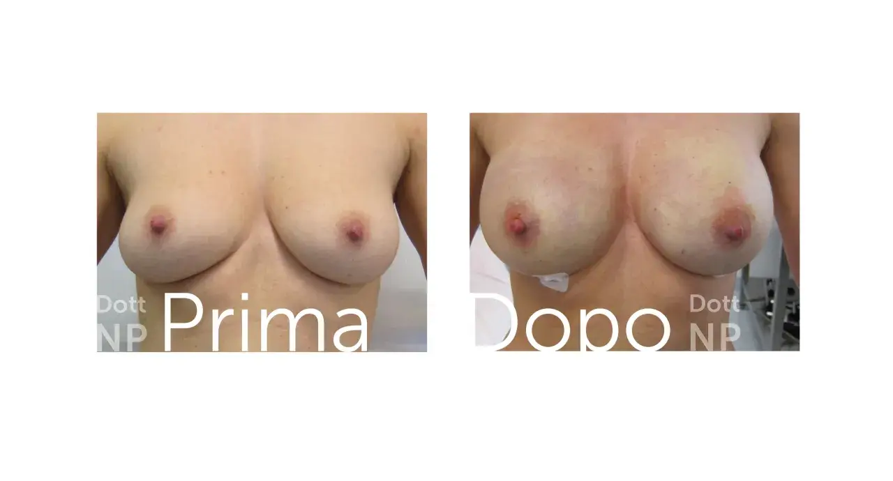 Prima e dopo: un confronto visivo che mostra un aumento del volume del seno, trasformando tette piccole in forme più piene e definite.