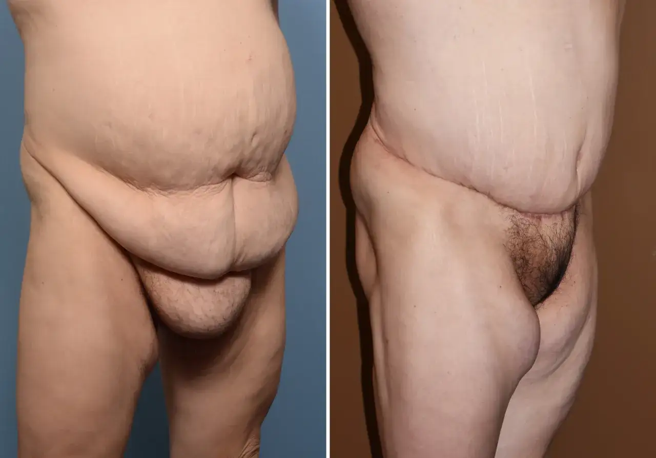 Prima e dopo liposuzione pube uomo: addome e zona pubica ridotti.