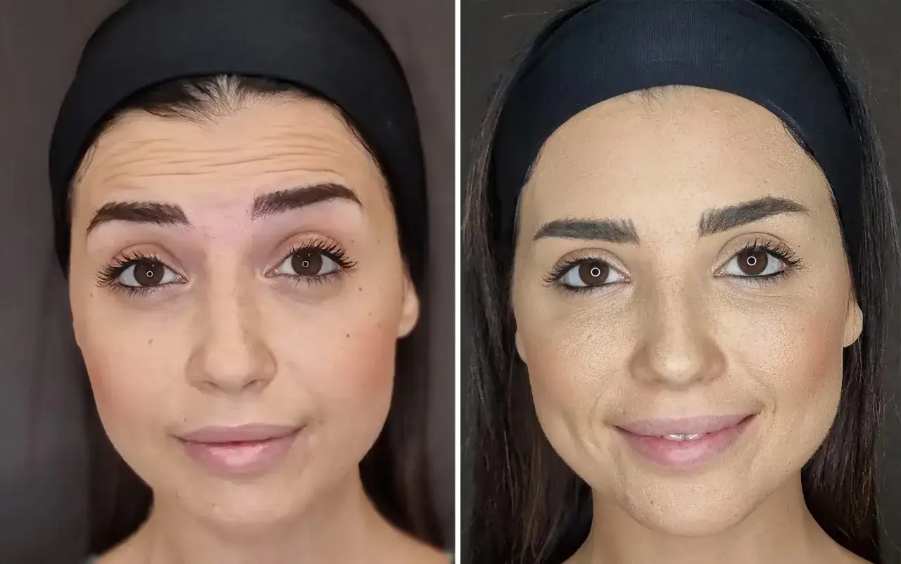 Prima e dopo: rughe frontali ridotte e un sorriso più pieno grazie al filler agli angoli della bocca.