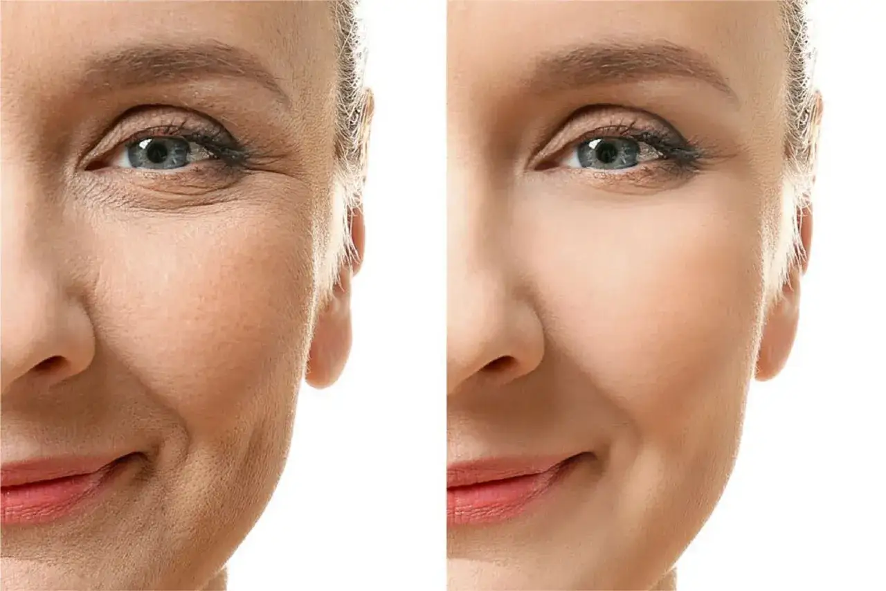 Confronto prima/dopo: pelle con rughe d'espressione e zampe di gallina, poi levigata grazie al botox.