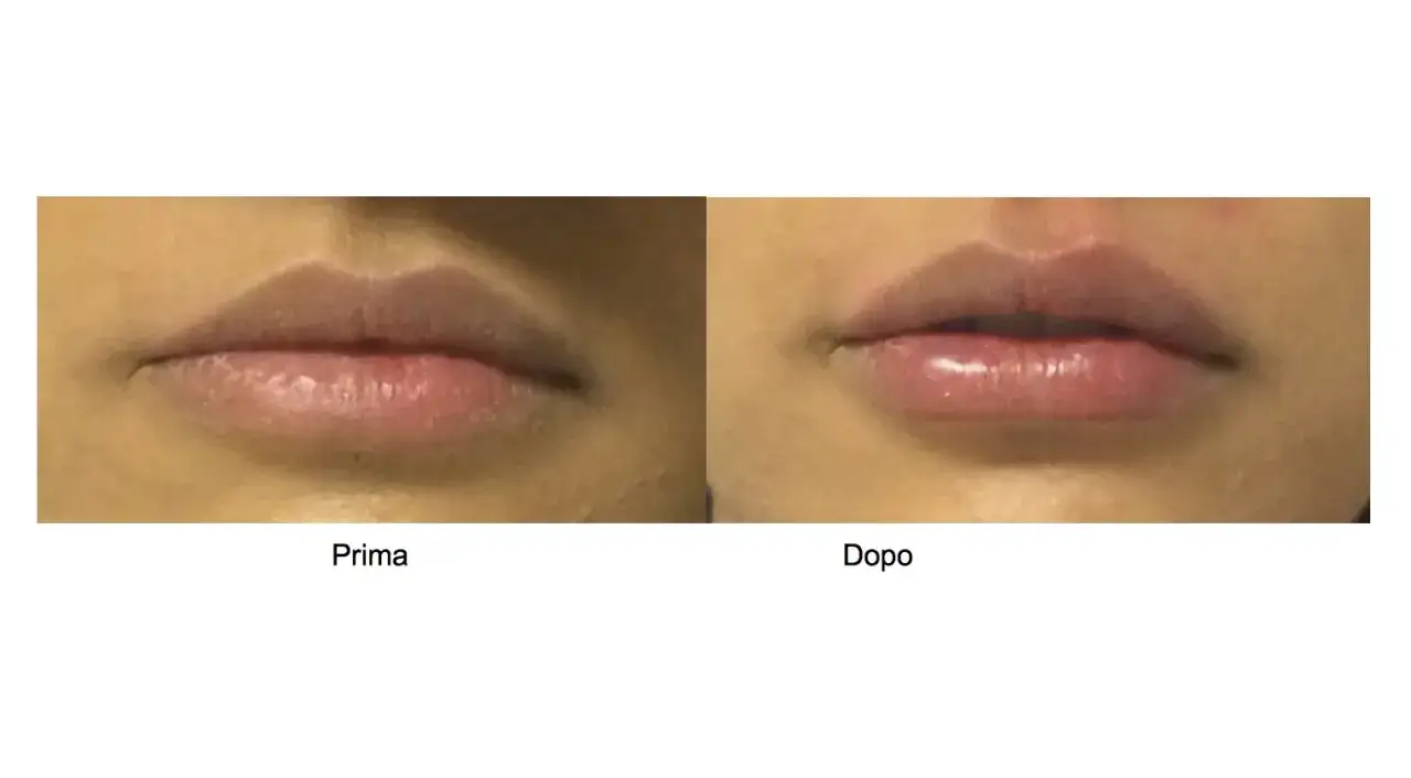 Prima e dopo: labbra più piene e definite grazie a un filler labbra naturale.