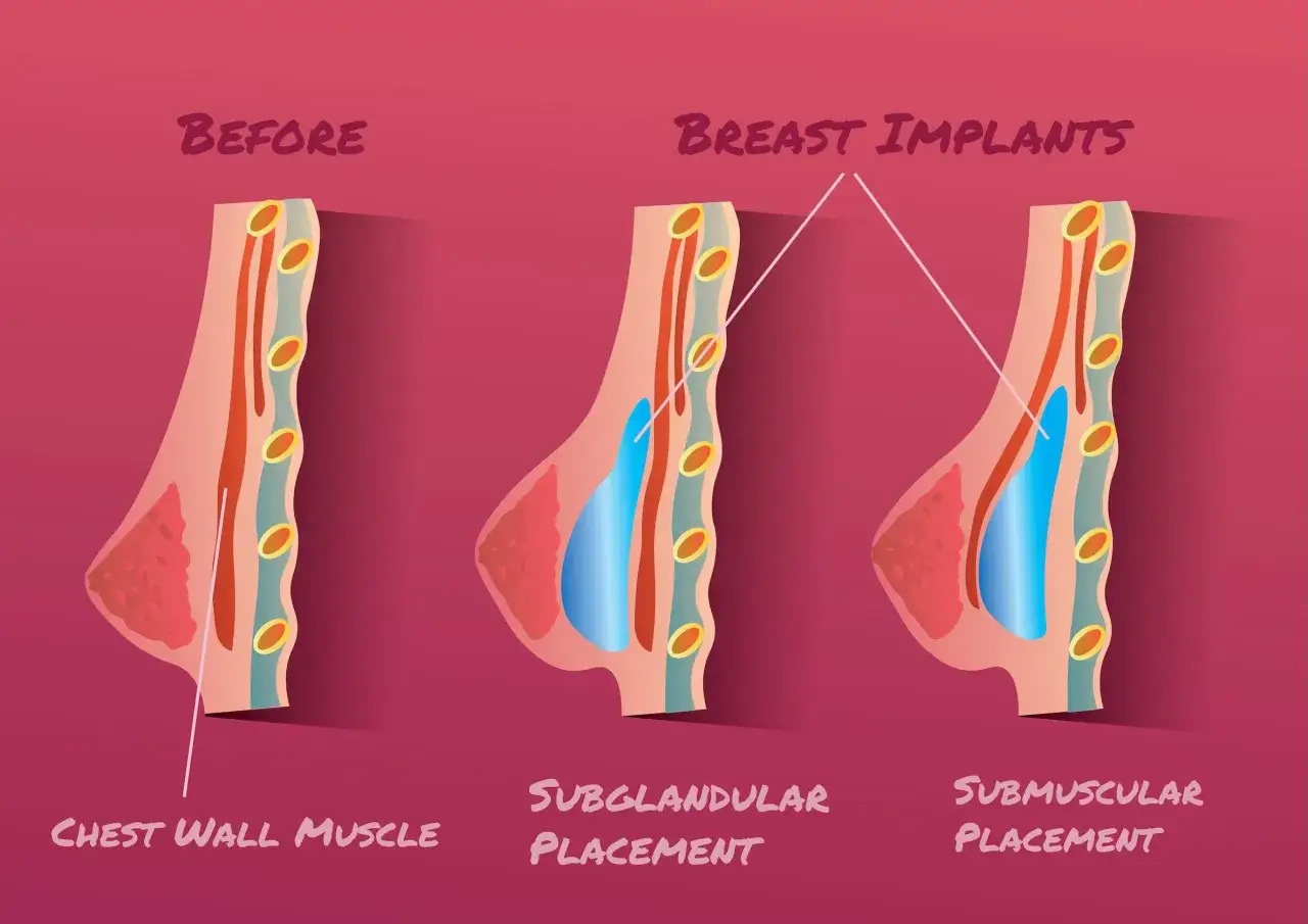 Illustrazione anatomica che mostra il prima e il dopo di una mastectomia e ricostruzione mammaria con protesi, evidenziando diverse posizioni di impianto.