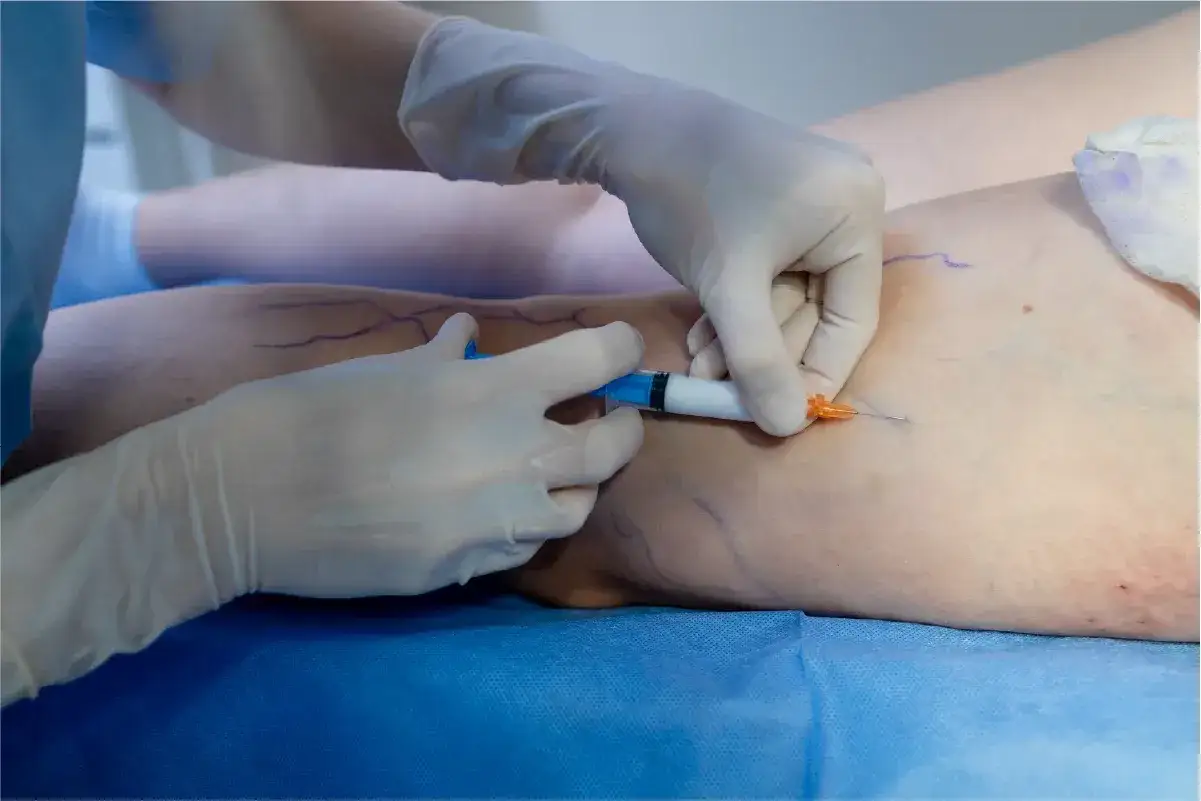 Mani guantate iniettano una soluzione per trattare i capillari sulle gambe, segnati con un pennarello.
