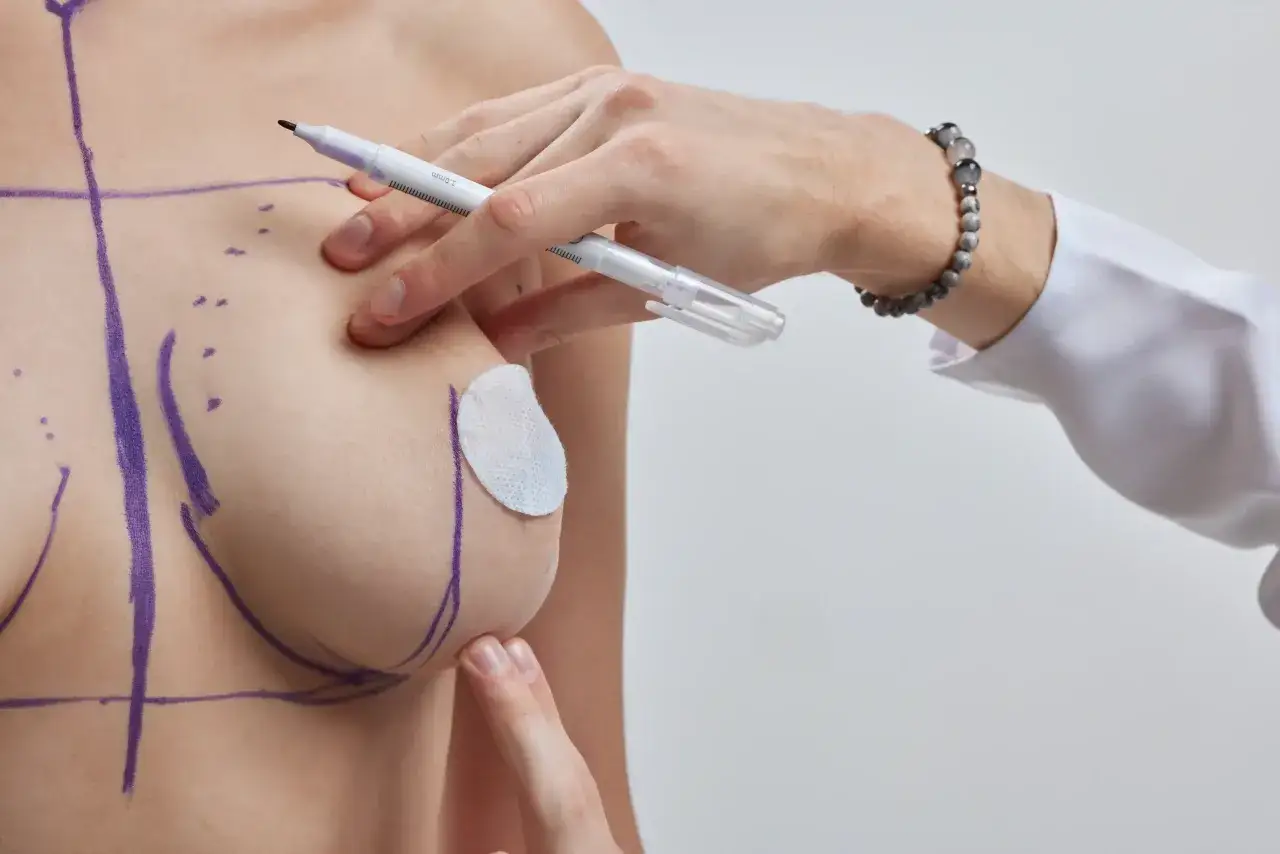 Un chirurgo disegna linee sul petto di una donna, pianificando un intervento per migliorare le tette piccole.