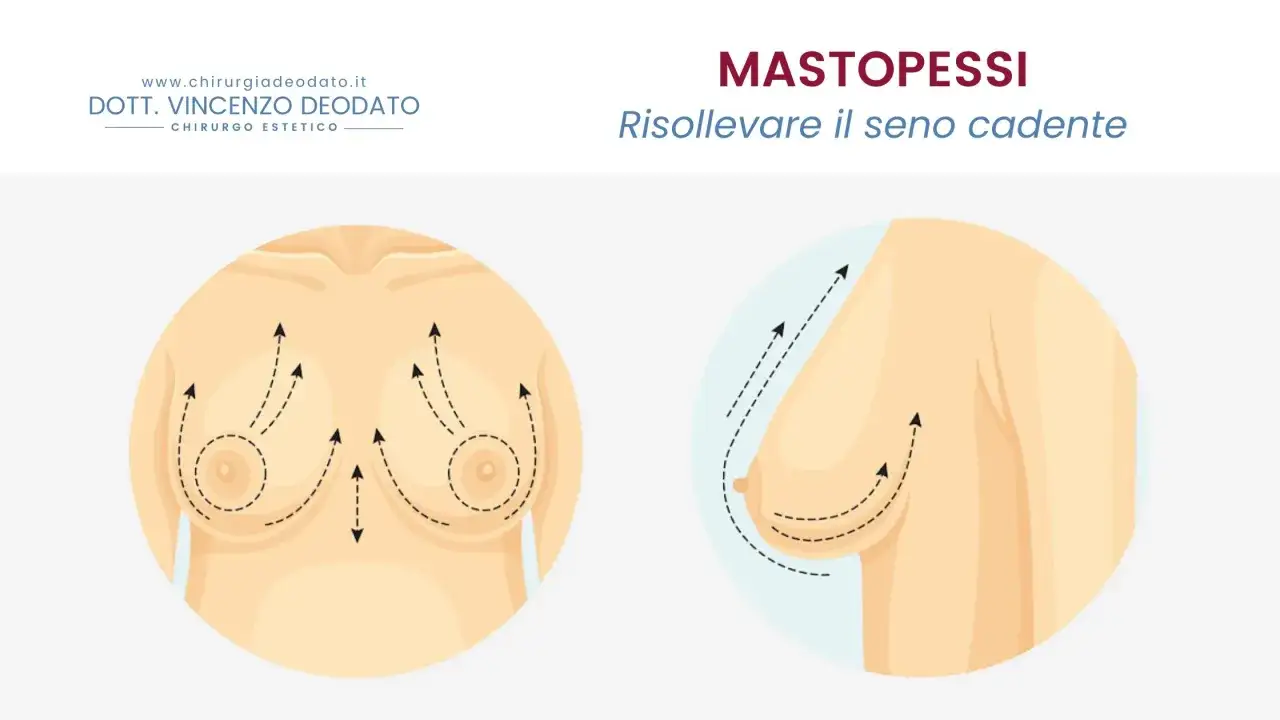 Illustrazione medica che mostra il sollevamento del seno cadente con frecce che indicano la direzione del movimento.