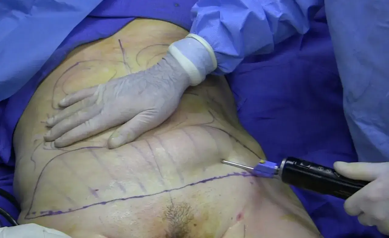 Mani guantate eseguono la liposuzione addome, con segni viola sulla pelle per guidare la procedura.