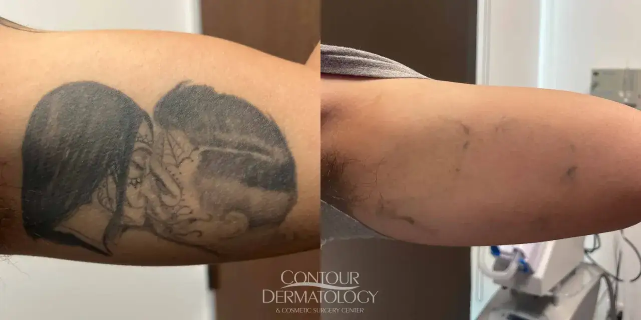 Prima e dopo la rimozione tatuaggi: un braccio con un tatuaggio scuro e poi con residui sbiaditi. Esperienze positive.