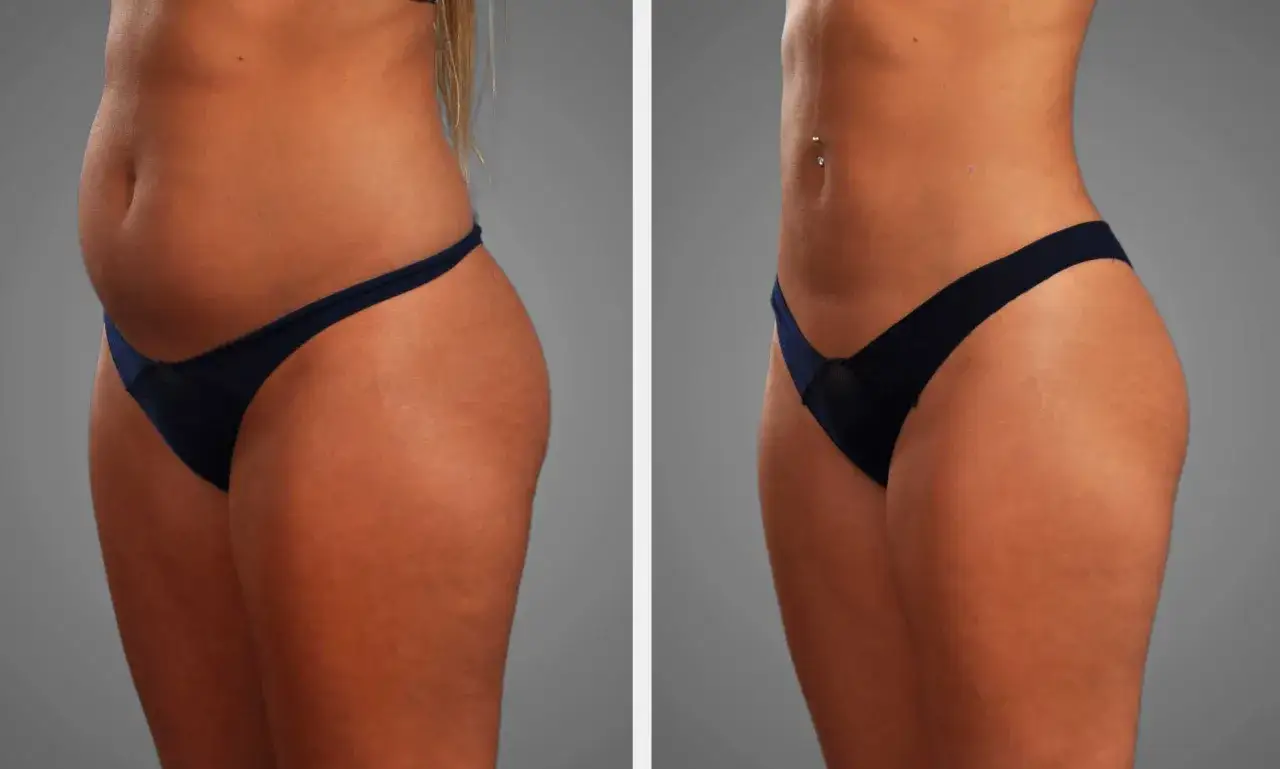 Liposcultura addome prima e dopo: un confronto visivo che mostra la trasformazione del corpo.