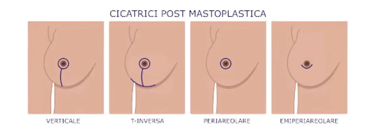 Illustrazione delle cicatrici post mastoplastica: verticale, T-inversa, periareolare, emi-periareolare. Informazioni sui rischi di riduzione seno.