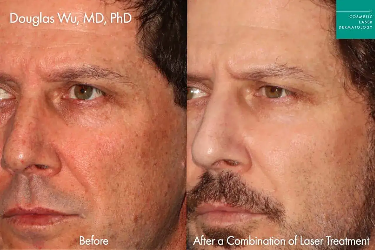 Viso con macchie solari prima e dopo il trattamento laser. La pelle appare più uniforme e luminosa.