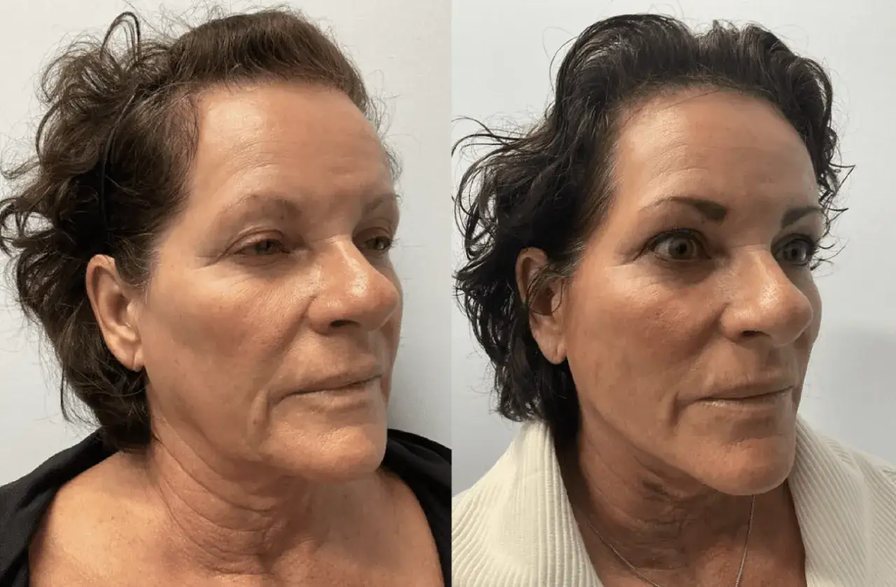 Prima e dopo: il viso di una donna mostra un miglioramento della pelle grazie ai fili tensori di collagene, con un aspetto più tonico e giovane.