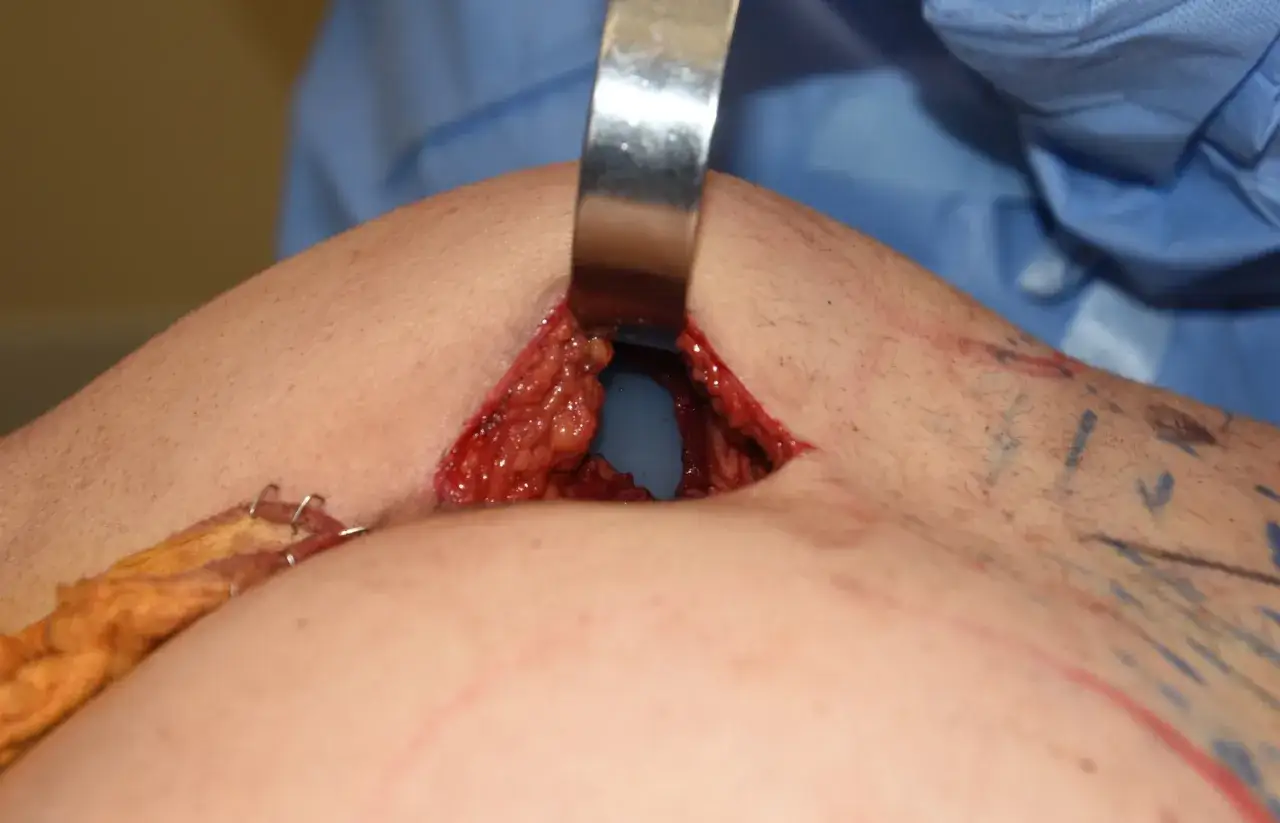 Chirurgia estetica: protesi glutei pro e contro. Incisione e dissezione del tessuto per l'inserimento.