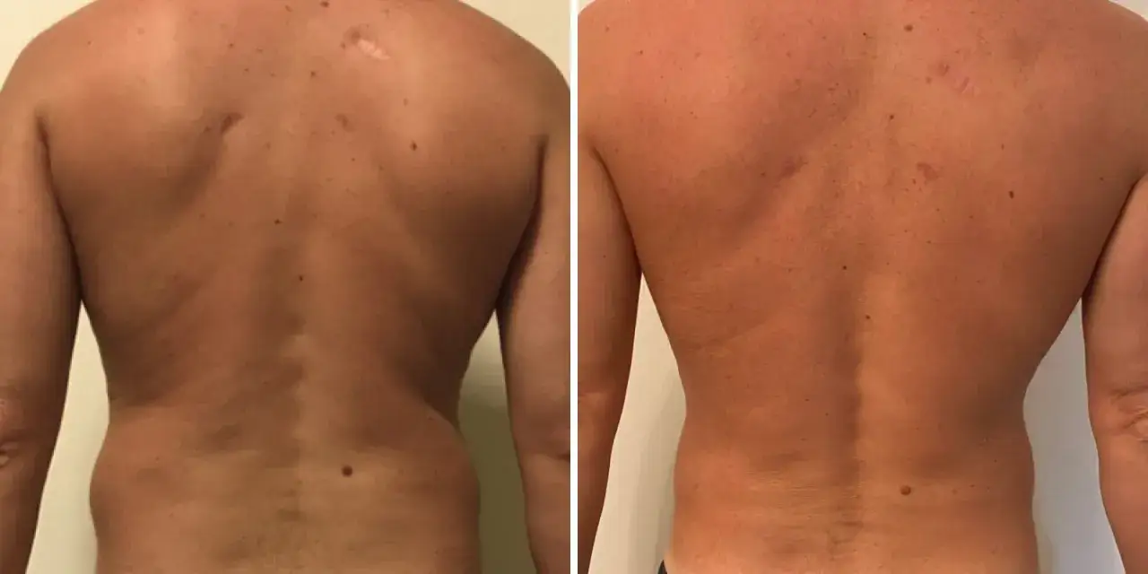 Risultati visibili di liposuzione schiena prima e dopo: la schiena appare più tonica e definita.