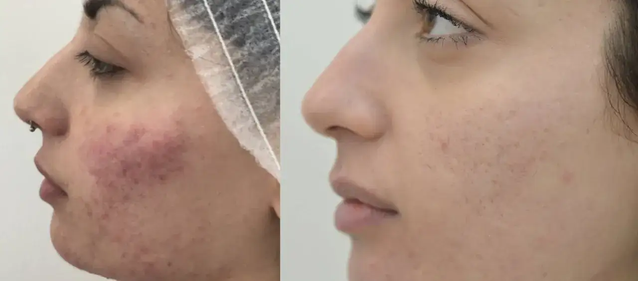 Prima e dopo trattamento: pelle arrossata e acneica prima, pelle più chiara e uniforme dopo. Nessun effetto collaterale visibile di Dermamelan.