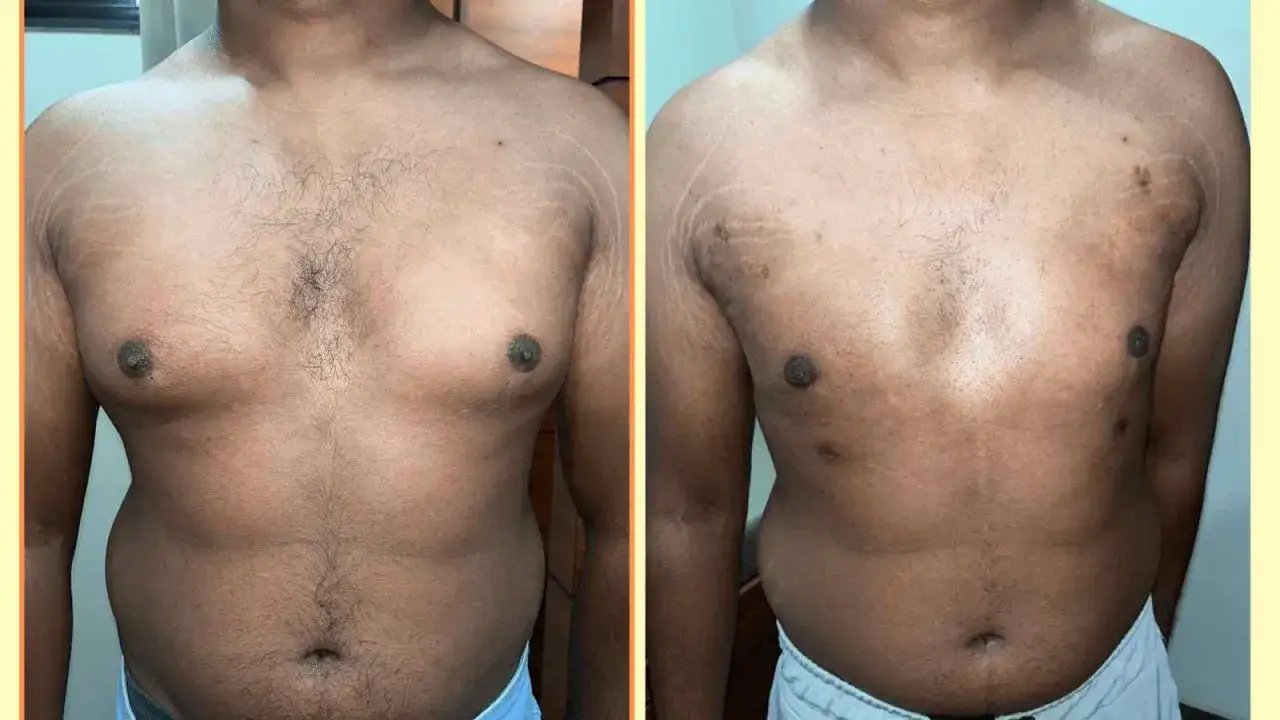 Prima e dopo: uomo con petto pi&ugrave; definito, risultato di un percorso per eliminare grasso petto uomo. Si notano miglioramenti nella tonicit&agrave;.