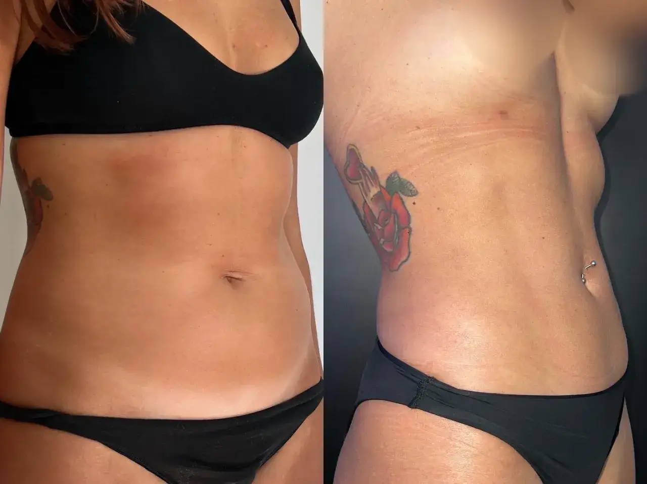 Addome prima e dopo vaser lipo: la silhouette &egrave; visibilmente pi&ugrave; definita, con una riduzione del grasso localizzato e un contorno pi&ugrave; armonioso.