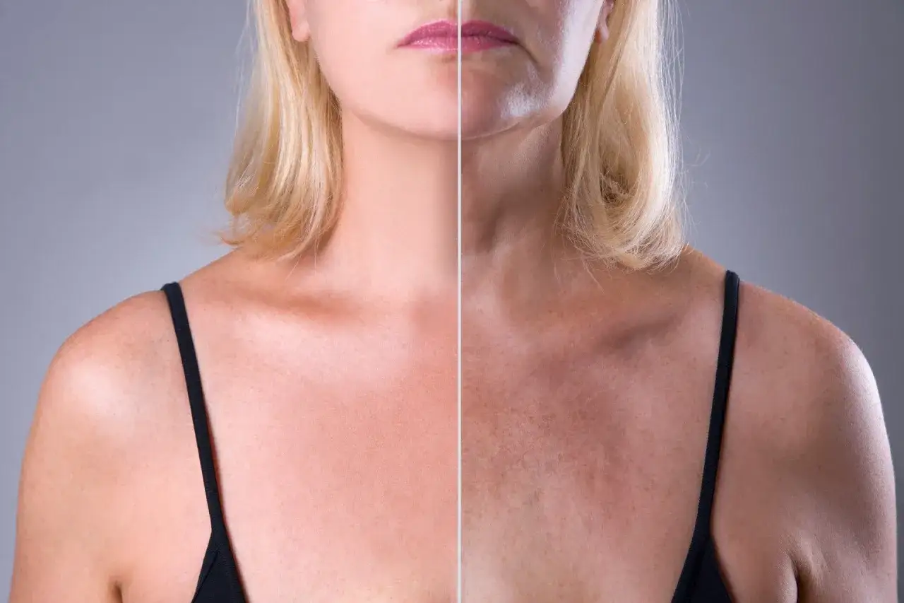 Confronto tra décolleté prima e dopo il trattamento per le rughe. La parte sinistra mostra una pelle liscia, la destra evidenzia le rughe décolleté come eliminarle.