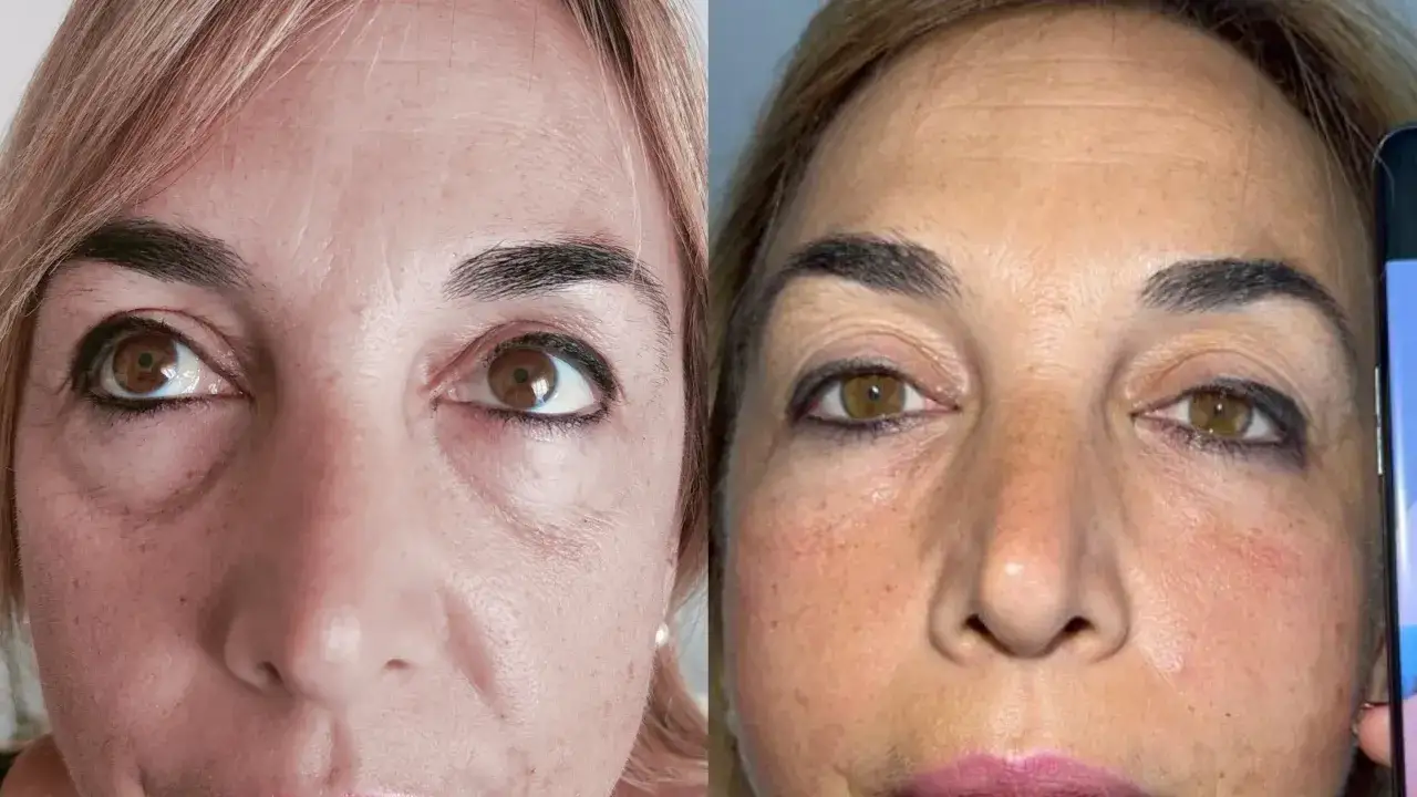 Prima e dopo: la biorivitalizzazione occhiaie ha migliorato la pelle, riducendo rughe e segni del tempo.