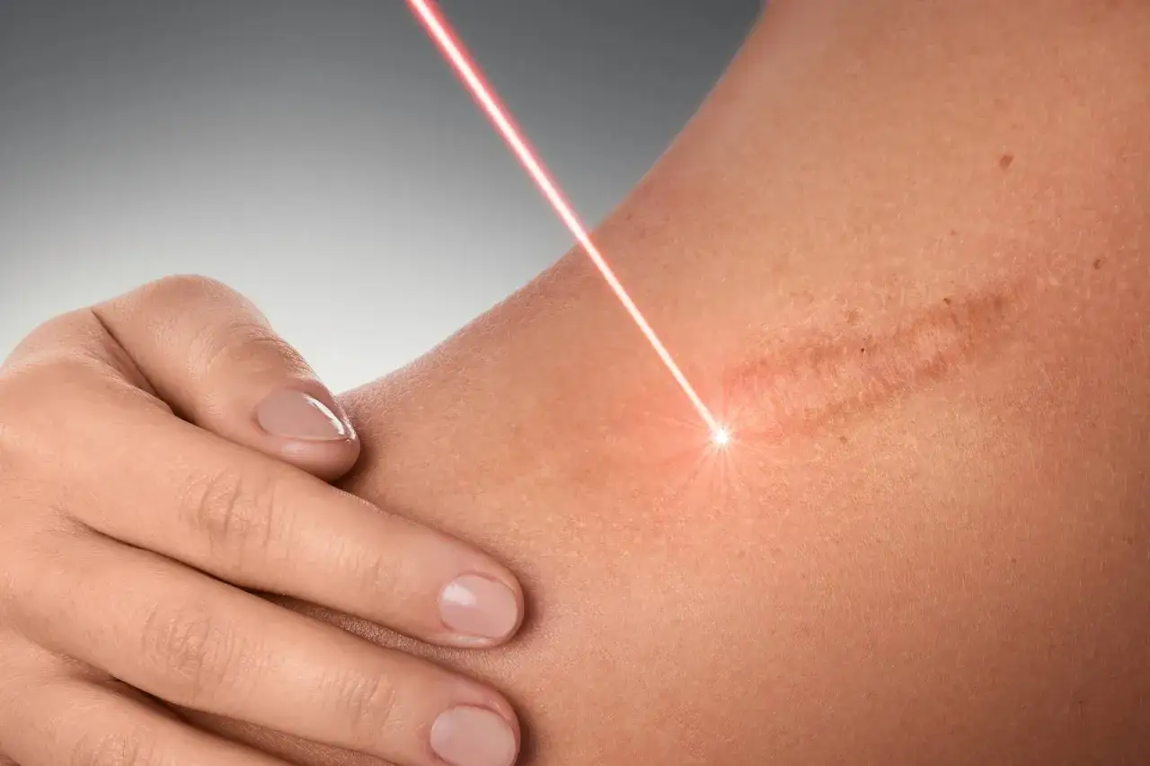 Trattamento laser per eliminare cicatrici da taglio. Una mano sfiora la pelle mentre un raggio rosso illumina la cicatrice.